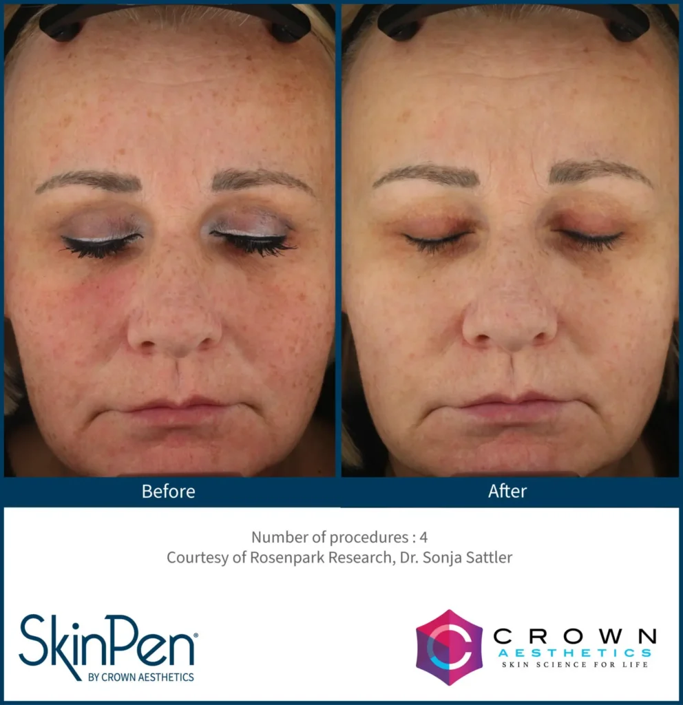 BA-SP_SolarLentigines_Rosenpark Research_DrSonjaSattler_Patient09_preview