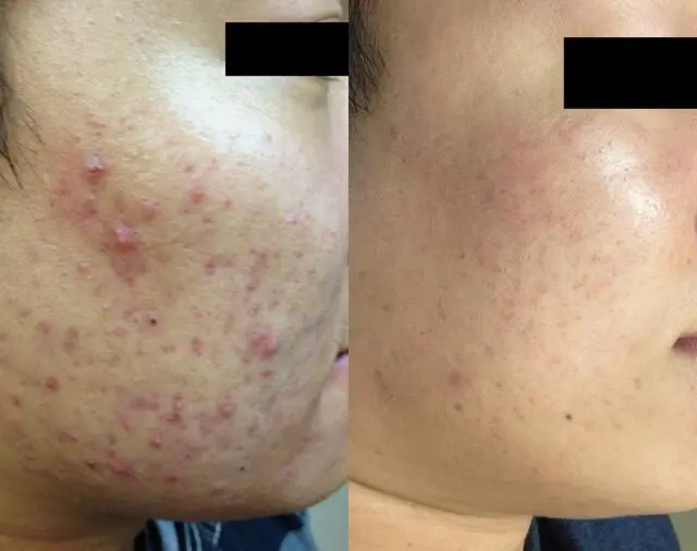 SkinPen_Acne_Orange_Male_27_Before-and-After-Picture_No watermark_preview 1